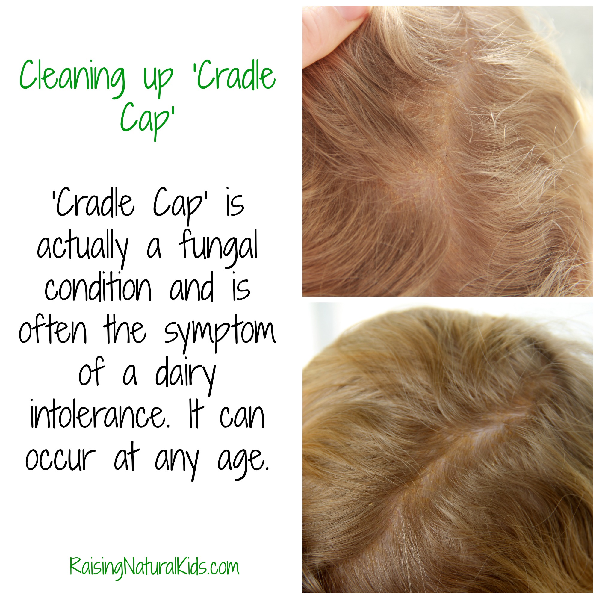 Cleaning up 'Cradle Cap'